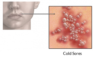 Canker Sore vs. Cold Sore: Telling the Difference Orajel™