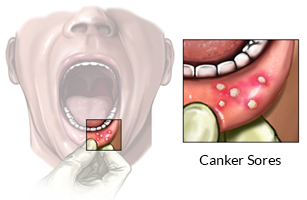 canker sore stages