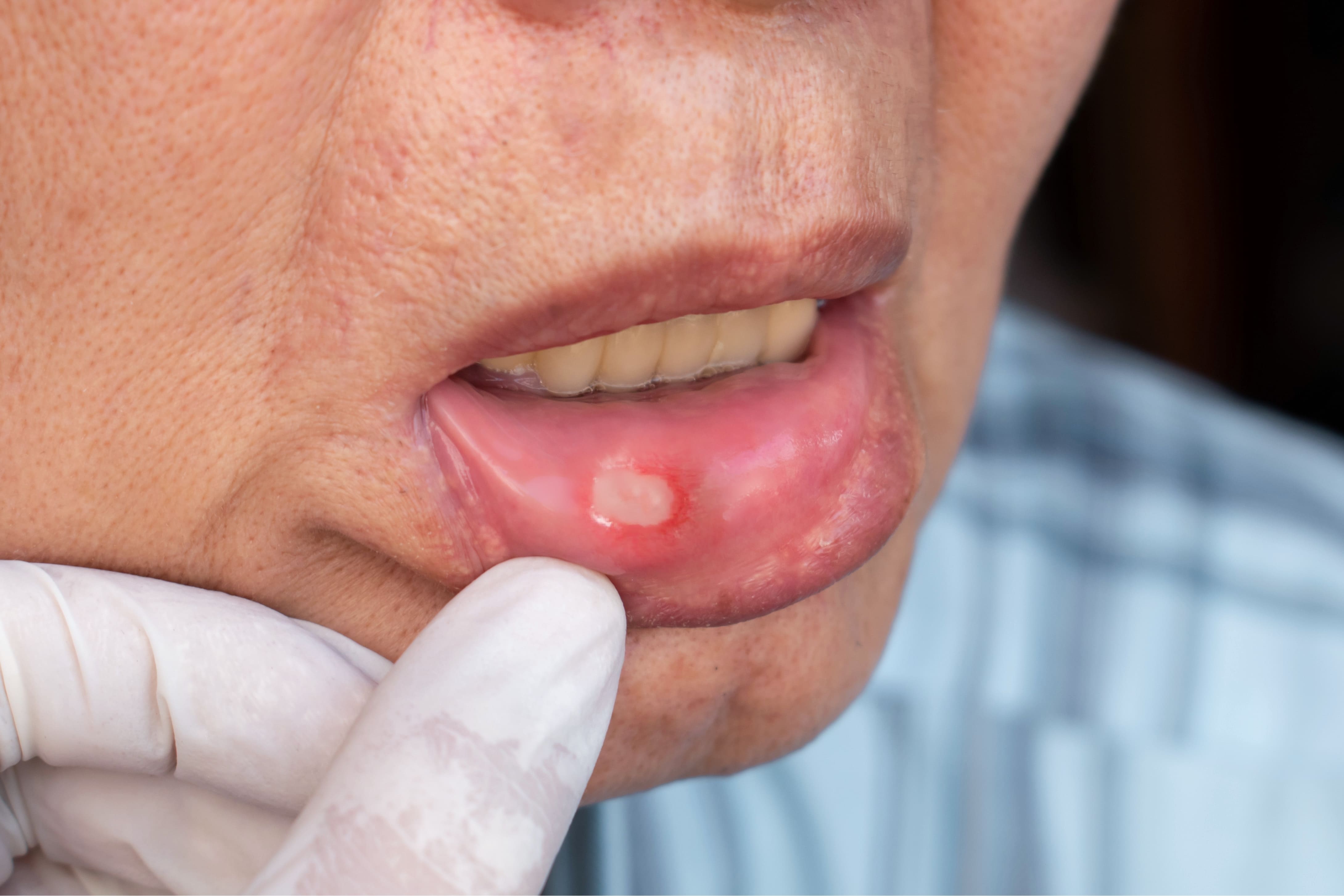 Asian man with a canker sore on his gums has his mouth examined.