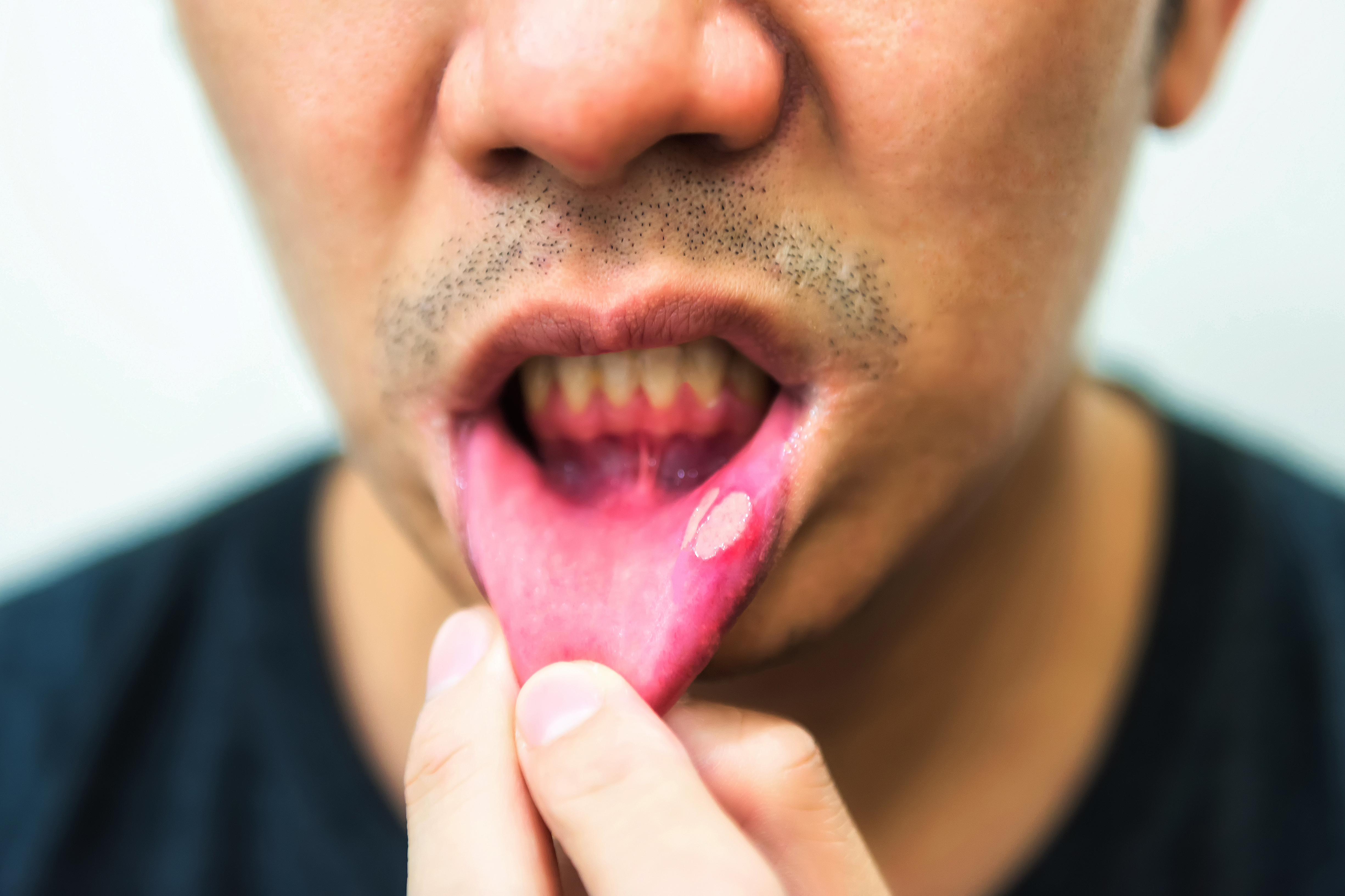 Man with a canker sore on the left side of his lower lip.
