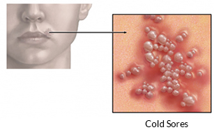 cold sores vs herpes